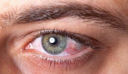 Göz Yanması Nedir, Neden Olur, Tedavisi Nasıl Yapılır